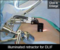 Illuminated retractor for DLIF