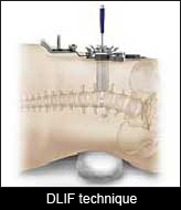 Illustration of DLIF technique