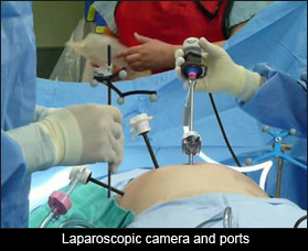 Laparoscopic camera and ports