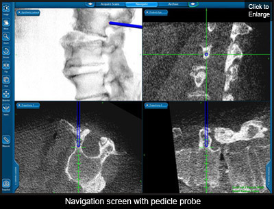 Navigation screen with pedicle probe